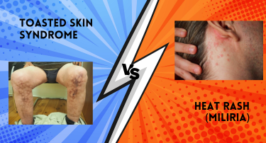 Toasted Skin Syndrome vs. Heat Rash (Miliria)