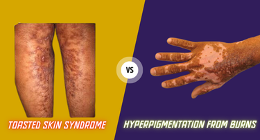 Toasted Skin Syndrome vs. Hyperpigmentation From Burns