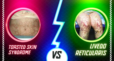 Toasted Skin Syndrome vs. Livedo Reticularis