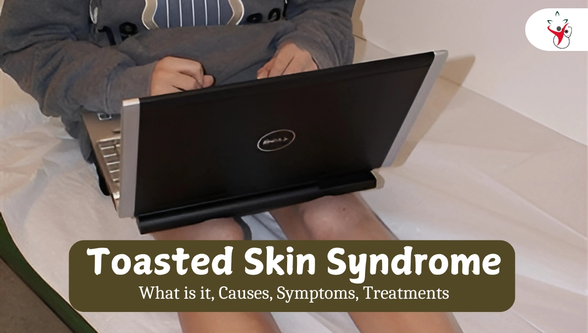 Toasted Skin Syndrome